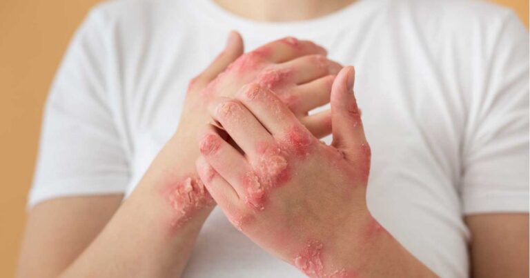 gesicht anfangsstadium hand fuß mund krankheit leichte form